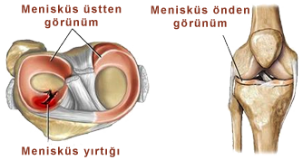menisküs yırtığı