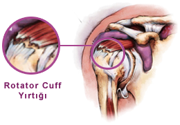 rotator cuff yıtığı